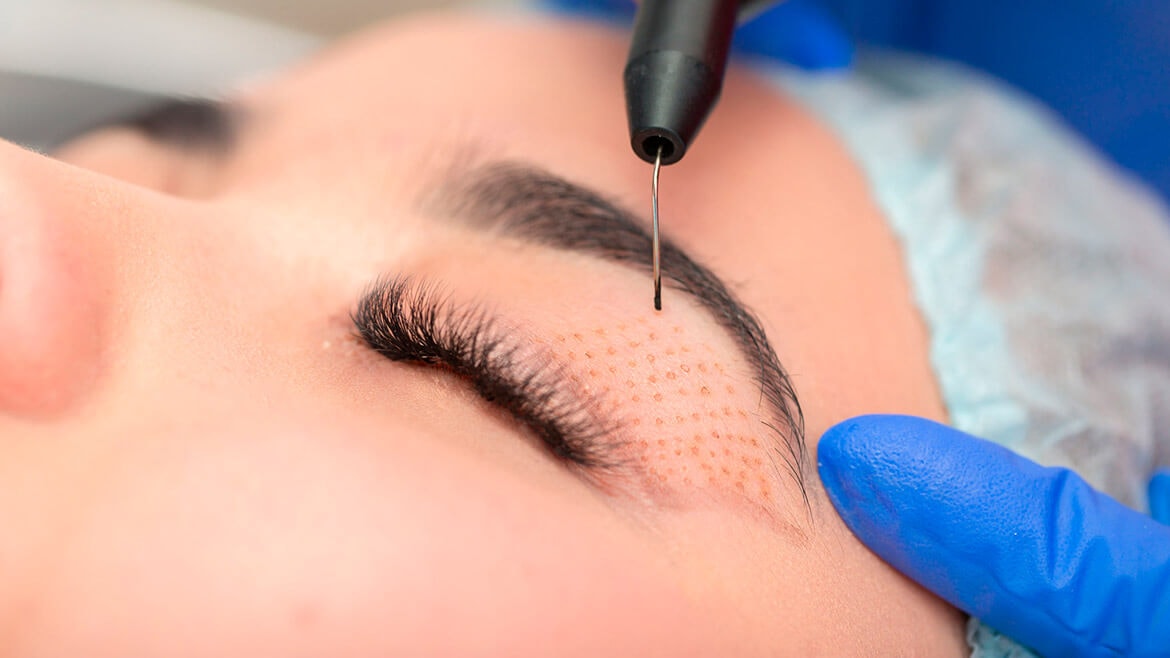 Plasma Pen Technician training at BC Medical Clinic